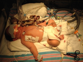 swollen from fluid and drugs. Chest tubes, breathing tubes, lights for jaundice, the works